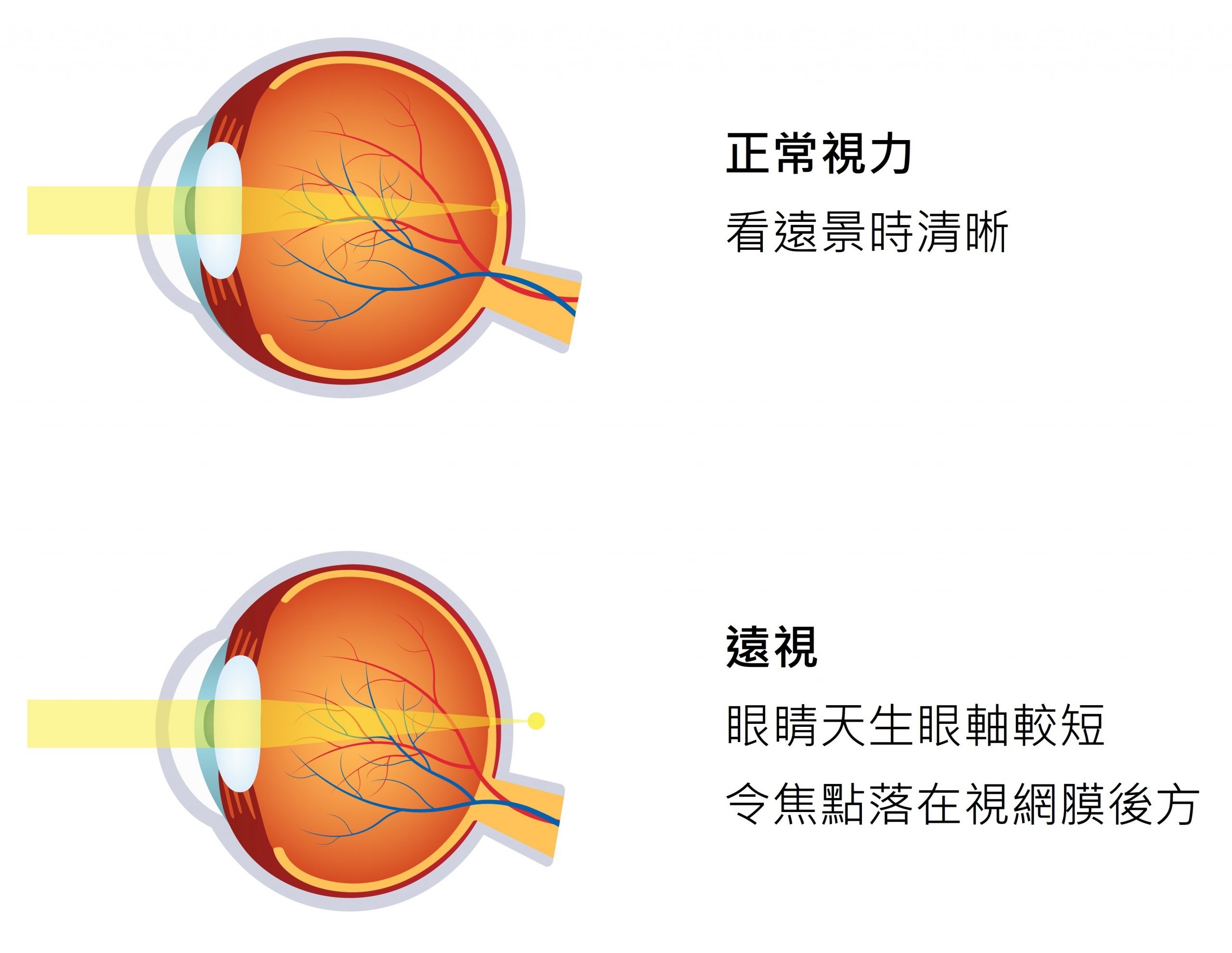 遠視眼球與正常眼球的分別