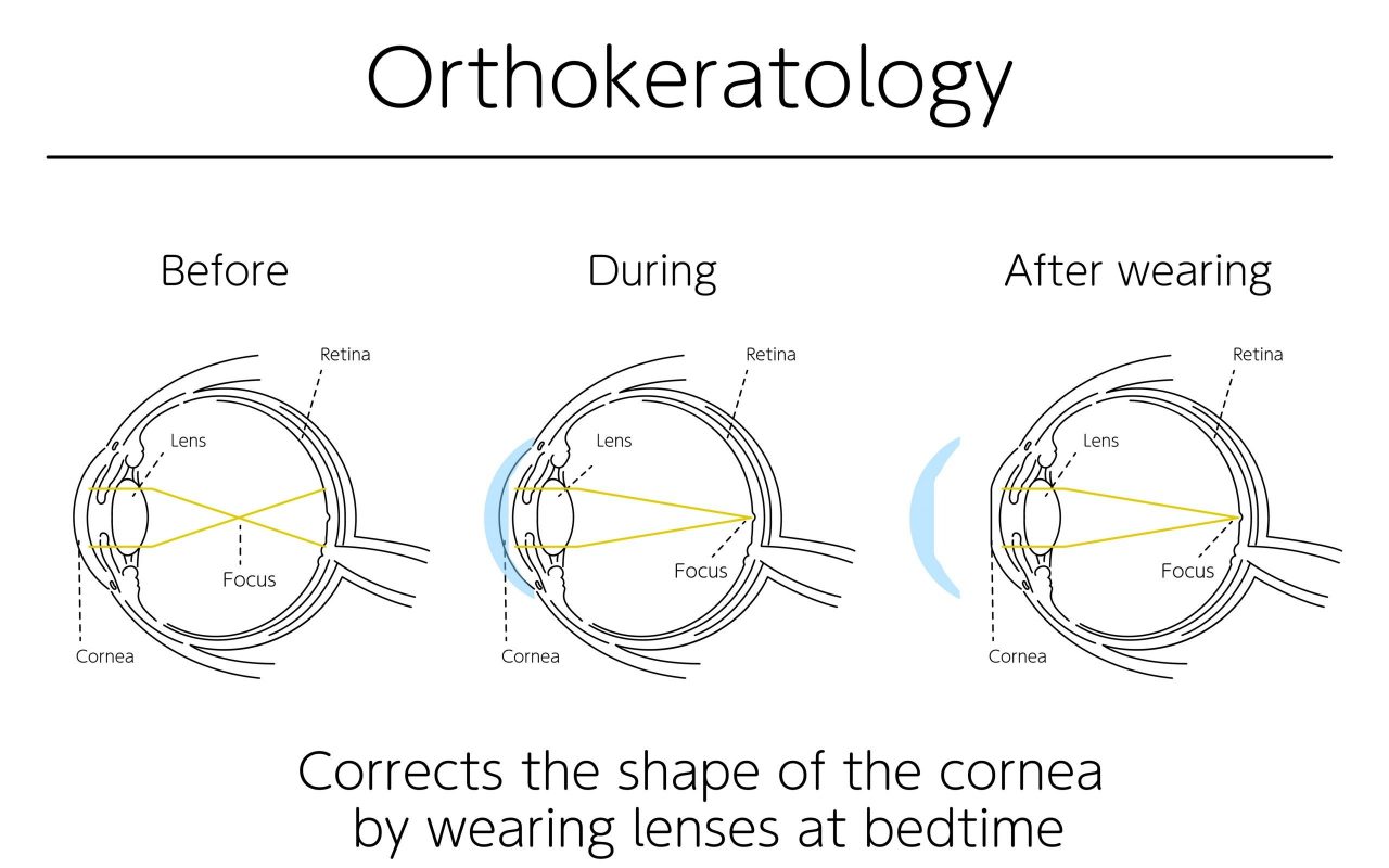 Wearing Ortho-K lenses at night alters the curvature of the cornea