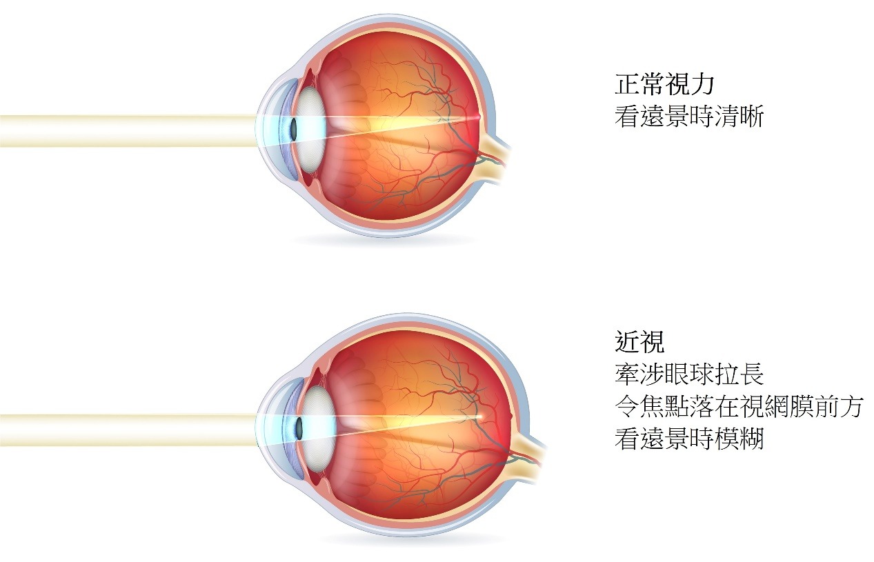 近視眼球與正常眼球的分別