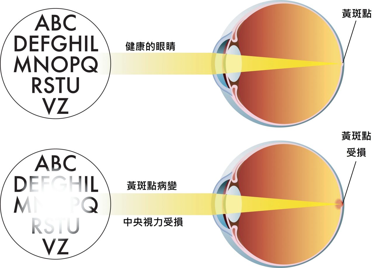 黃斑點病變會引致中央視力受損